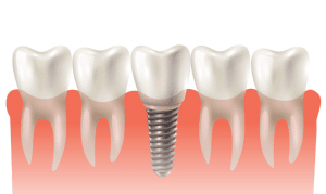 dental implants oak forest il