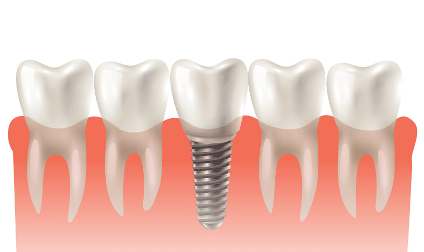 Why Dental Implants Are The Best Option To Restore Missing Teeth?