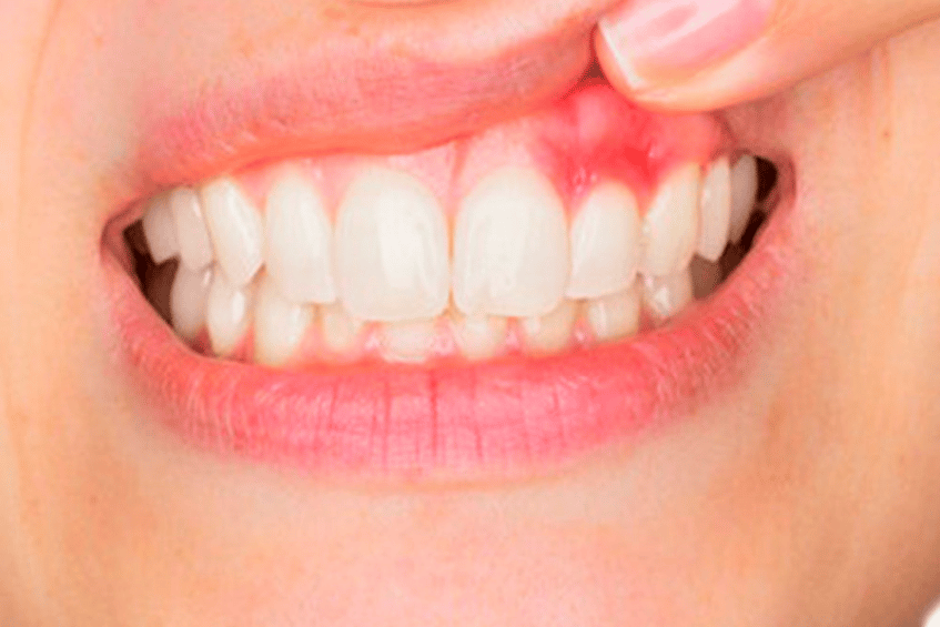 gum disease signs