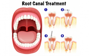 root canal treatment