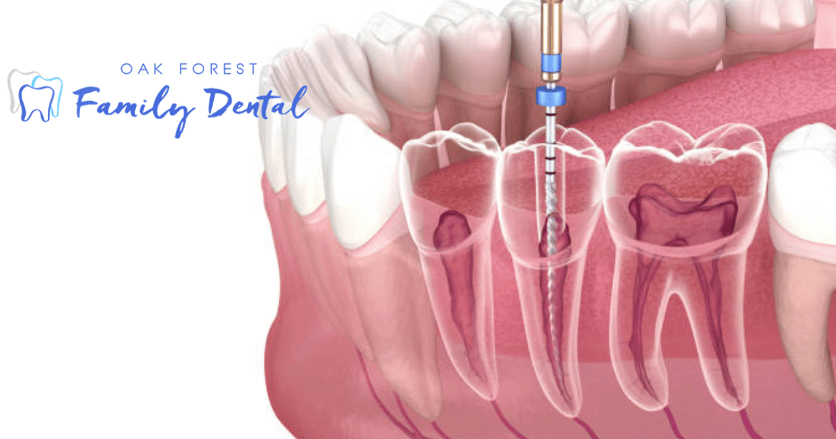 best dentist in Oak Forest, dentist in Oak Forest, Oak Forest Dentist, Root Canal Therapy in Oak Forest,