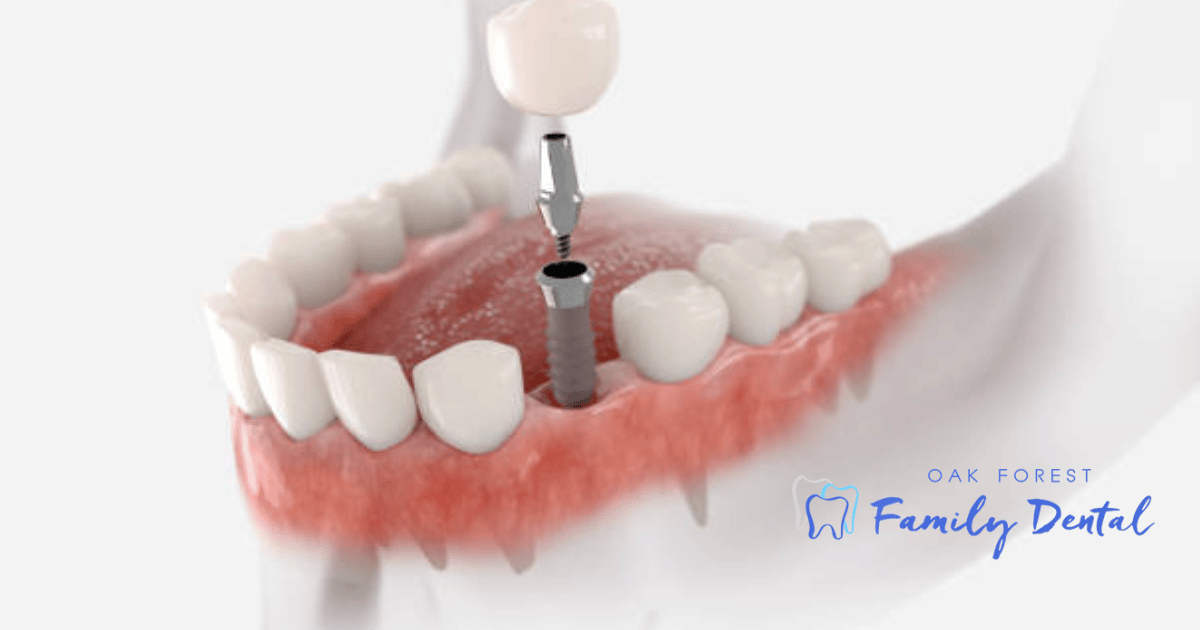 Why Are Dental Implants So Popular?