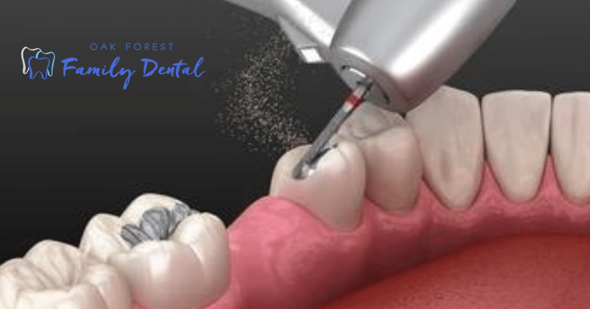 Dental Filling, dental office in Oak Forest, dentist in Oak Forest,