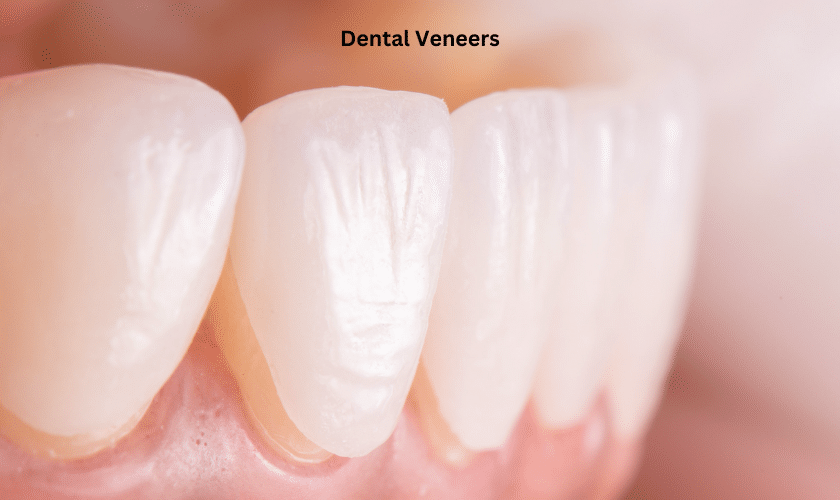 Is Veneer Teeth Worth It?