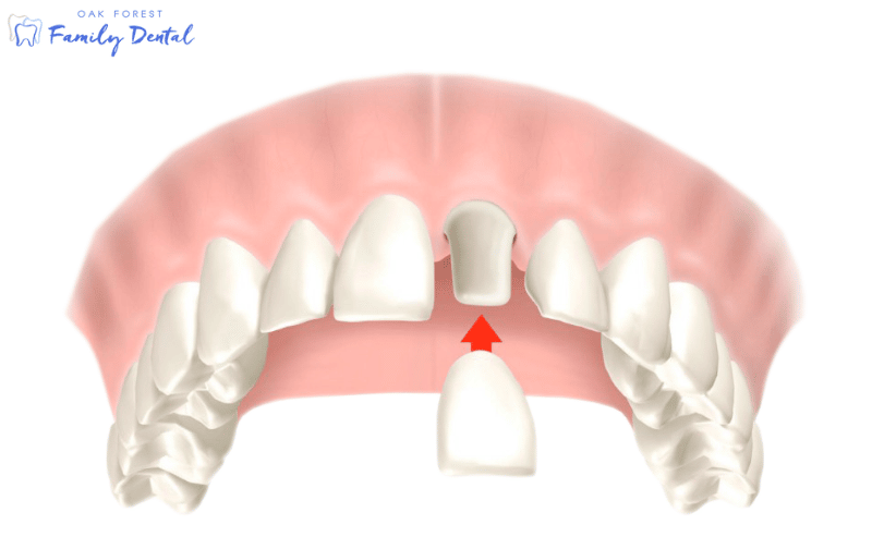 What Are The Benefits Of Dental Crown Treatment?