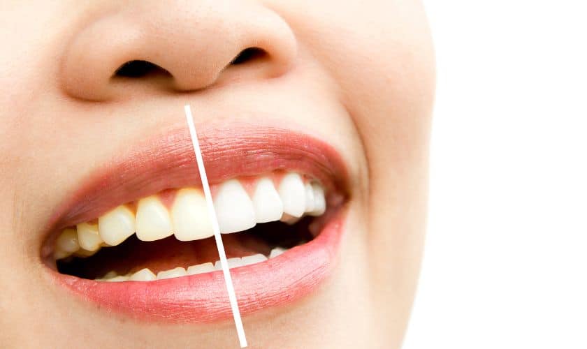 How to Maintain Your White Smile After Whitening Treatment