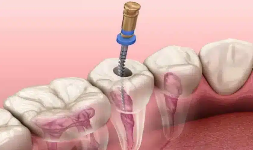 Say Goodbye To Tooth Pain: Understanding Root Canal Treatment