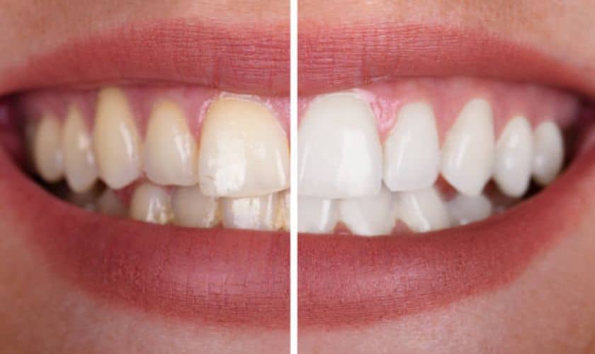 Teeth Whitening