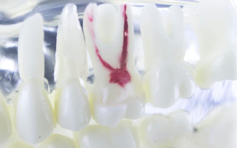 Root Canal Treatment - Advanced Solutions Family Dental