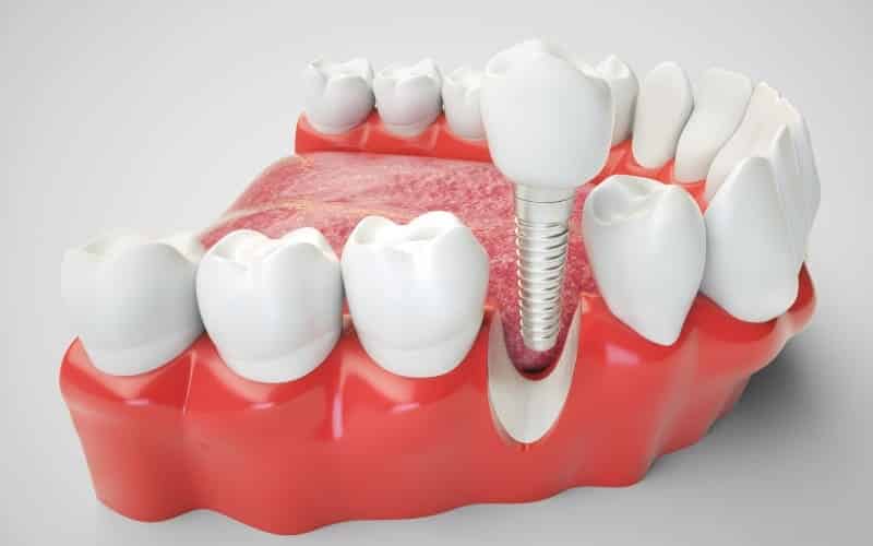 Dental Implants - Advanced Solutions Family Dental, IL