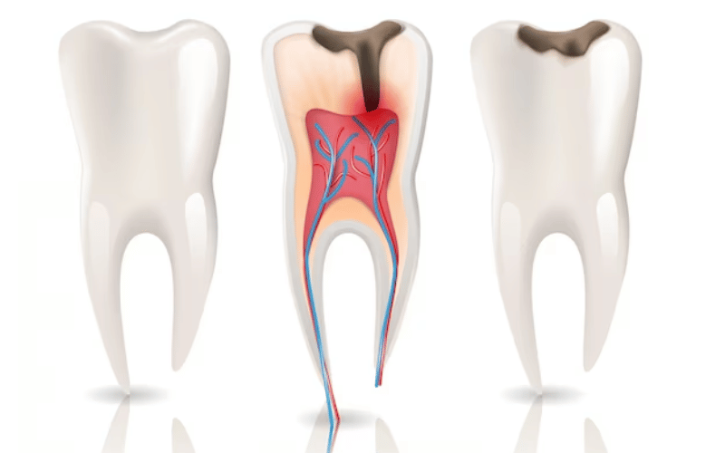 What Hurts More, A Root Canal Or Tooth Extraction?
