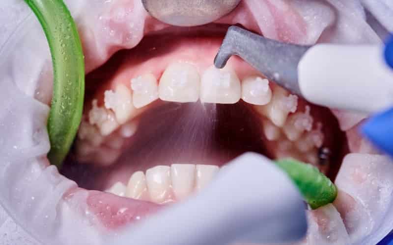 Antibiotics Before Dental Cleaning