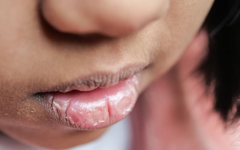 dry mouth tooth infection
