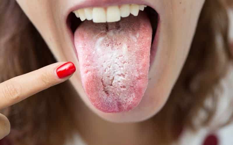 What Does Your Tongue Say About Your Oral Health?