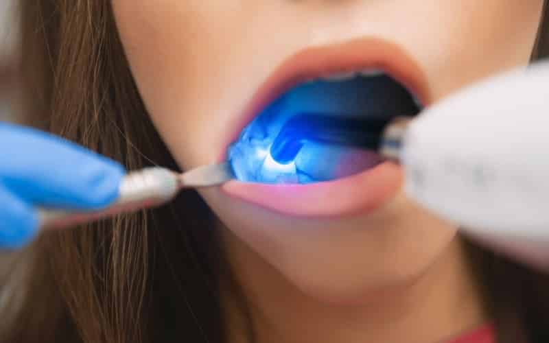 Velscope for Oral Cancer Screening