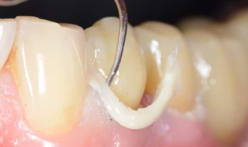 How To Dissolve Dental Cement At Home