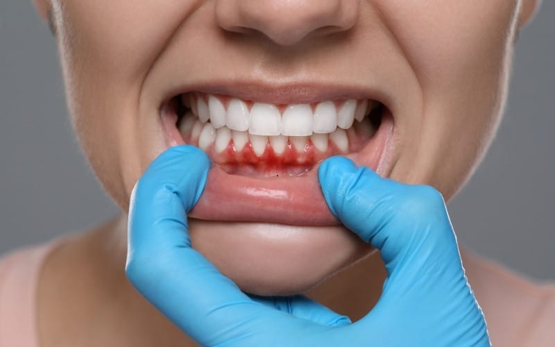 How to Recognize Signs of Gum Recession?