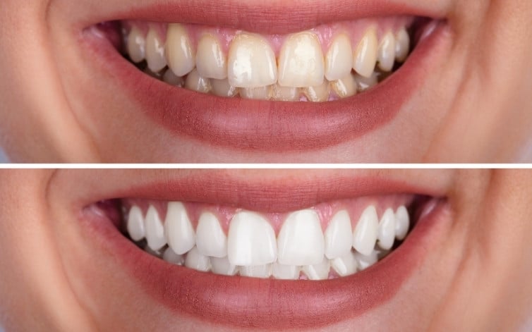 How to Maintain Your Bright Smile After Teeth Whitening?