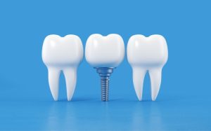 key factors to consider before getting dental implants