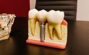 support your jawbone health with dental implants