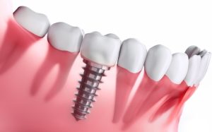 tips to get long-term success of your dental implants
