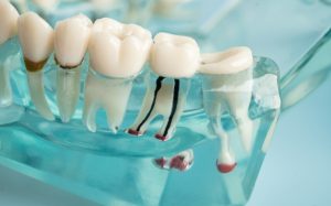 is a root canal necessary for damaged teeth