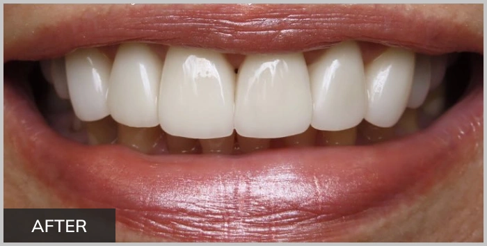 img-advanced-solutions-family-dental-after