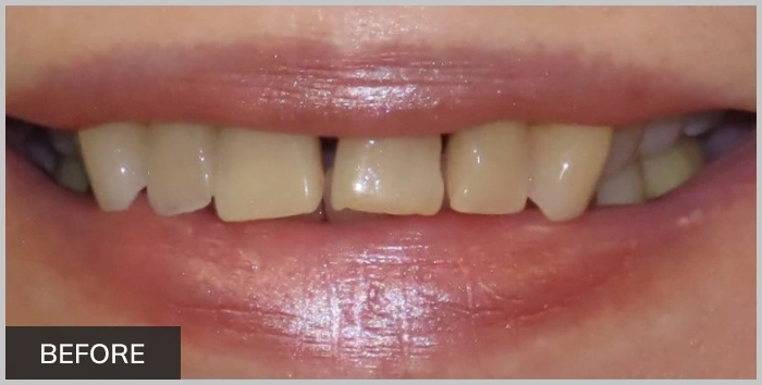img-advanced-solutions-family-dental-before